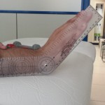 Rehabilitación a domicilio para personas con prótesis de muñeca Rehabilitación a domicilio para personas con prótesis de muñeca