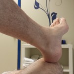 La constancia como clave del éxito en la rehabilitación de prótesis de rodilla La constancia como clave del éxito en la rehabilitación de prótesis de rodilla