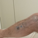 Ventajas de la fisioterapia tras la colocación de una prótesis de rodilla Ventajas de la fisioterapia tras la colocación de una prótesis de rodilla