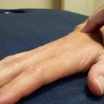 La fisioterapia como solución para controlar el dolor tras un implante de prótesis